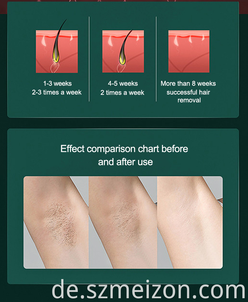 ice laser hair removal cost